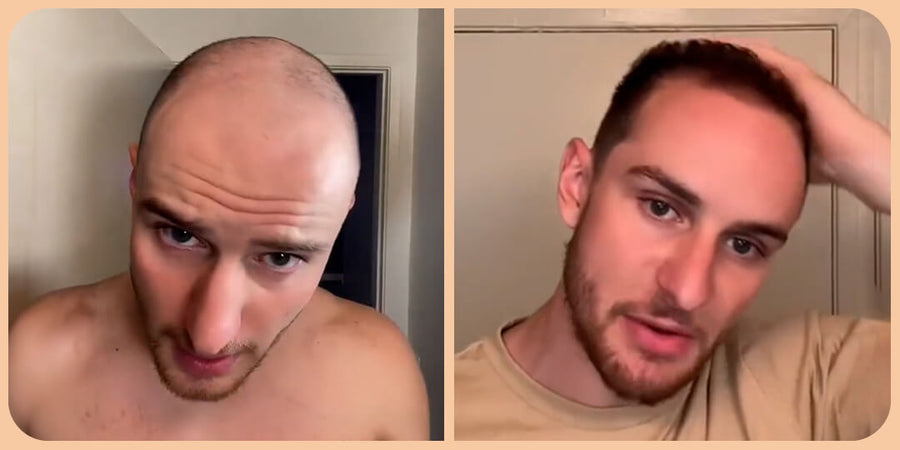 🔥🔥Gyors hajnövekedés keverék 🔥🔥🎉 Hatékony kezelés a hajhullásra Növelje a haj mennyiségét gyorsan🎉